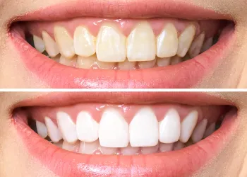 Diş Beyazlatma Öncesi Sonrası Fotoğraf Nasıl Çekilir?